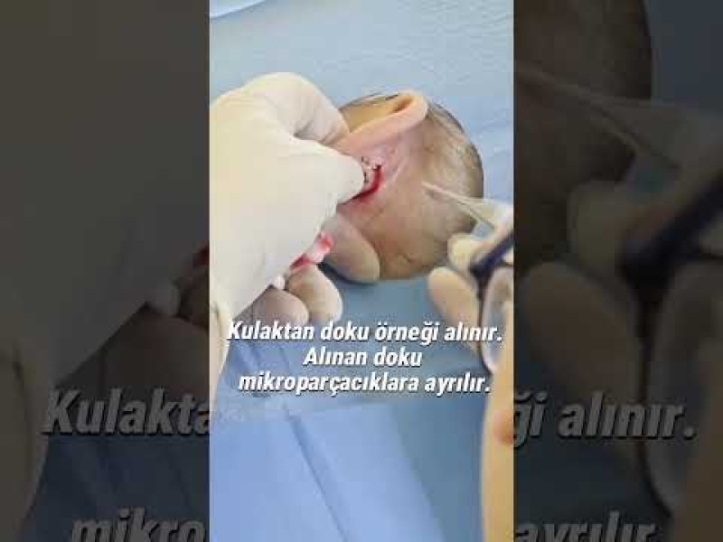 Otolog Mikrogreft,Otolog Mikrogreft Tedavisi